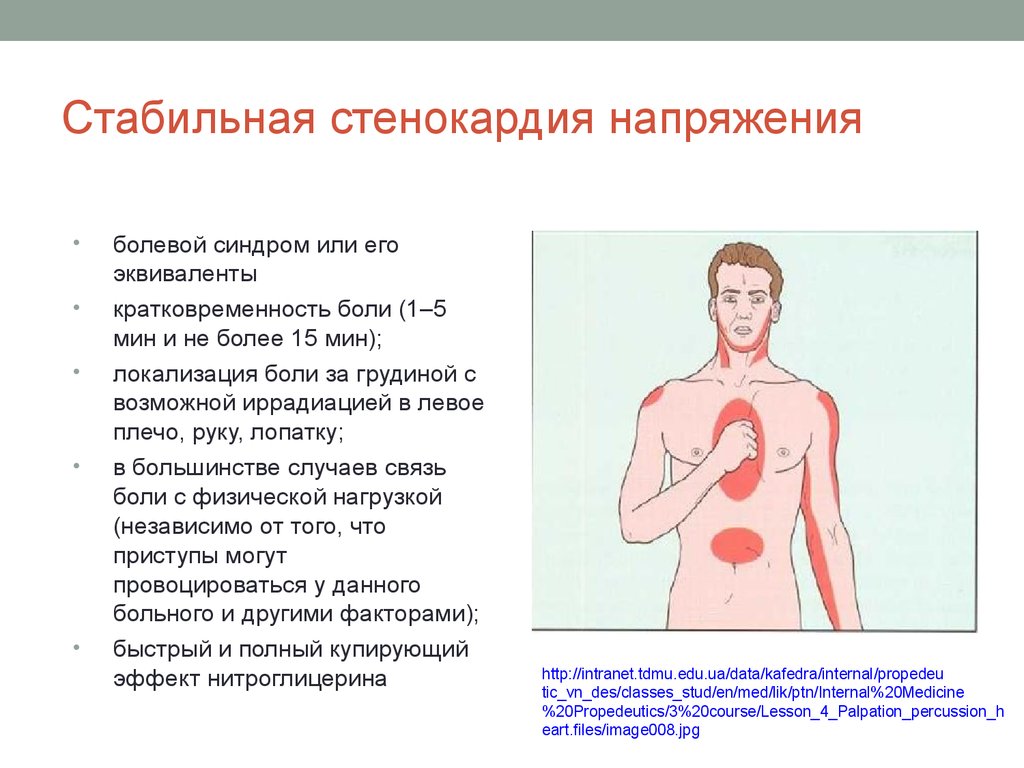 Стенокардия этаж. Стабильная стенокардия синдромы. Стенокардия напряжения локализация боли. Боль при стенокардии напряжения.