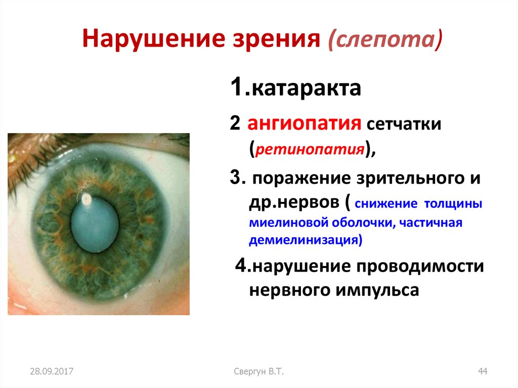 Причины слепоты. Нарушение зрения. Нарушения зрительного анализатора (слепота).