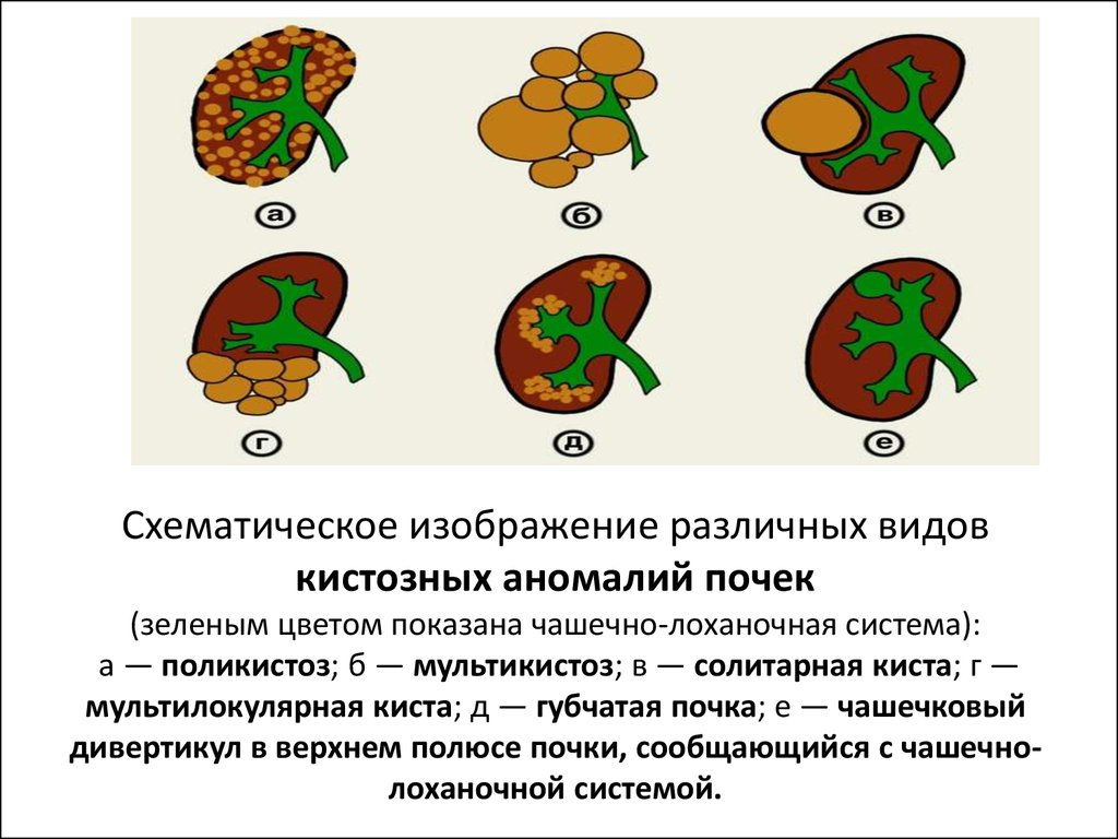 Кисты почек причины возникновения