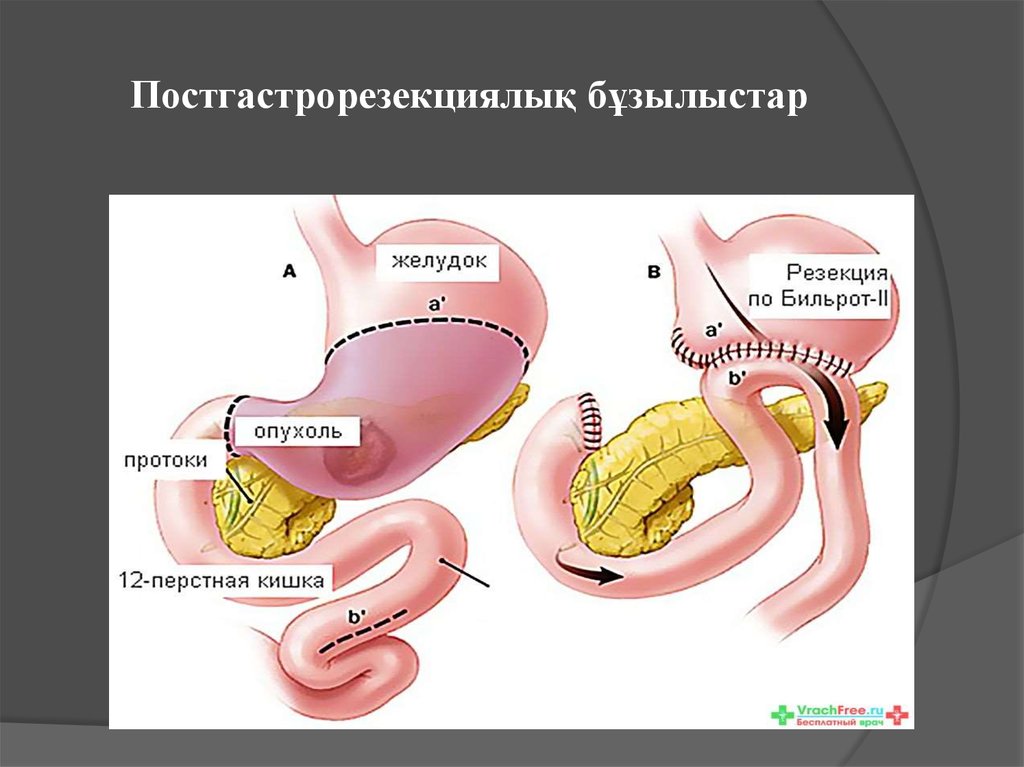 Операция резекция желудка. Резекция желудка Бильрот 2 техника. Резекция желудка Бильрот. Резекция желудка Бильрот 1 схема. Операция по Бильрот 1 и Бильрот 2.