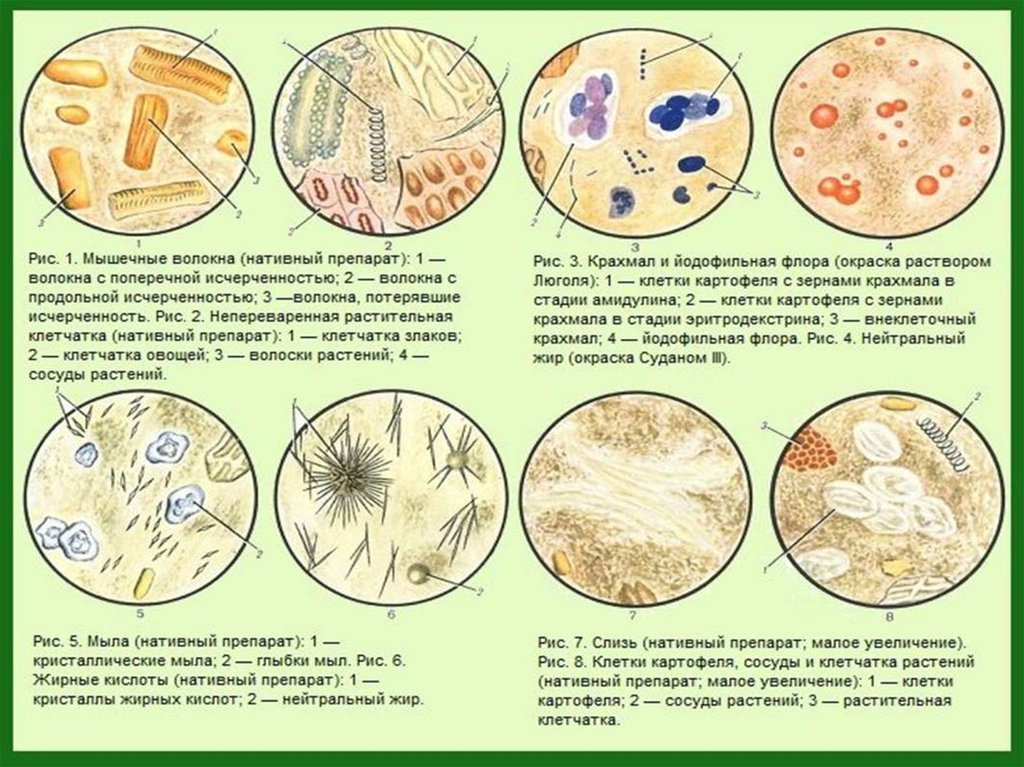 Копрограмма грибы обнаружены у взрослого. Микроскопия кала растительная клетчатка непереваримая. Копрологическое исследование микроскопия препаратов кала. Атлас копрограмма микроскопия. Микроскопия нативного препарата кала.