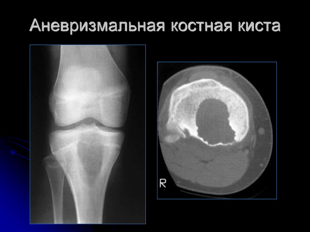 Киста бедренной. Аневризмальная костная киста рентген. Аневризмальная костная киста мрт. Солитарная киста бедренной кости. Аневризматическая костная киста бедренной кости на рентгене.