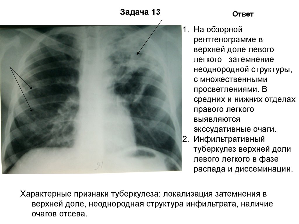 Пневмония фтизиатр