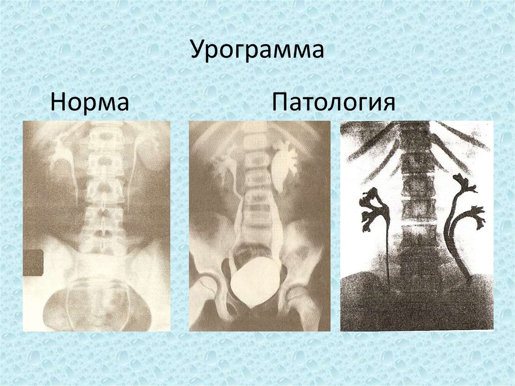 Нормальная аномалия. Экскреторная урография патология. Обзорная урограмма рентген. Экскреторная урография рентген.