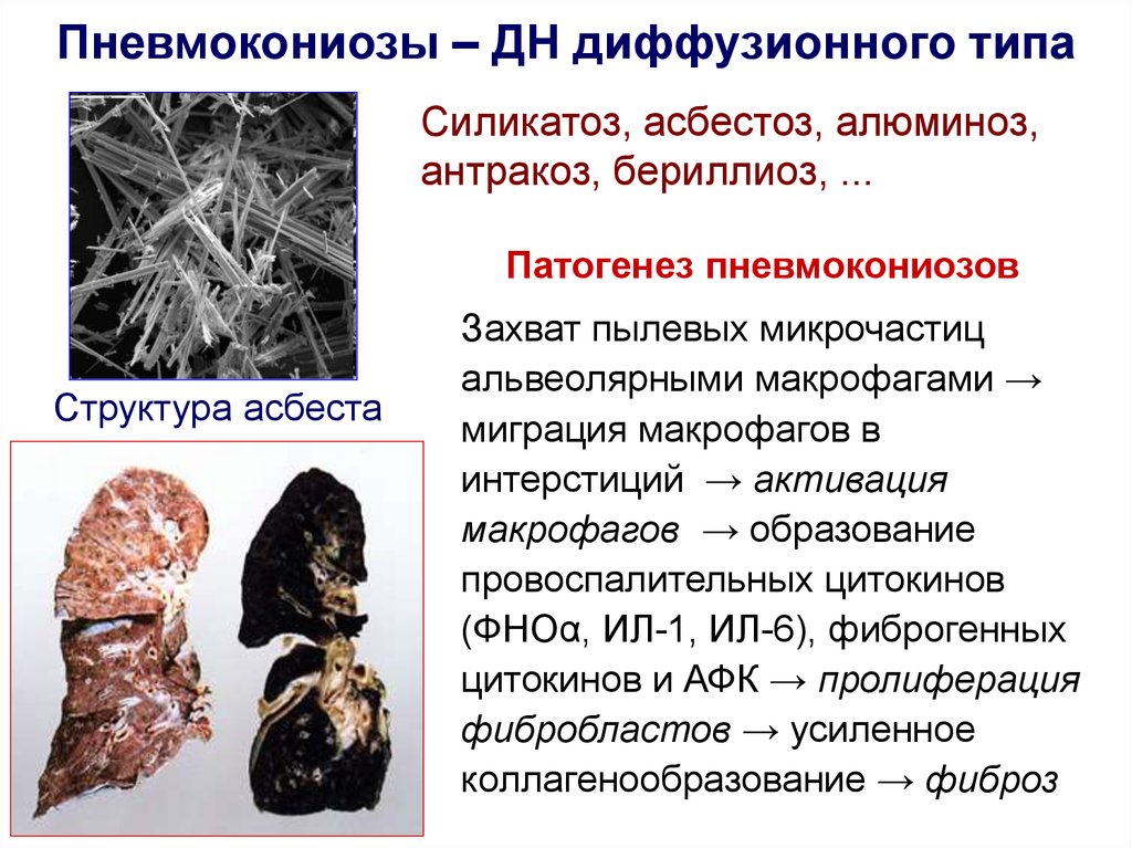 Пневмокониоз легких. Пневмокониоз : бериллиоз. Пневмокониоз : силикоз, асбестоз, Антракоз, бериллиоз. Силикатозы асбестоз патогенез.