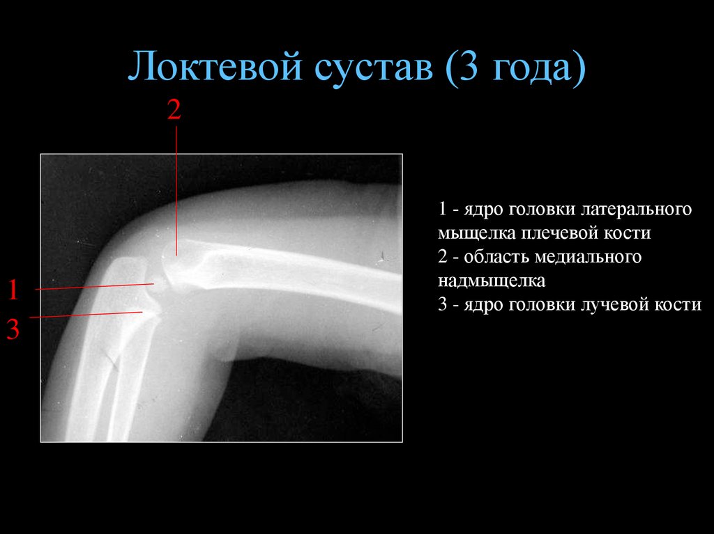 Головка Локтевой Кости Фото