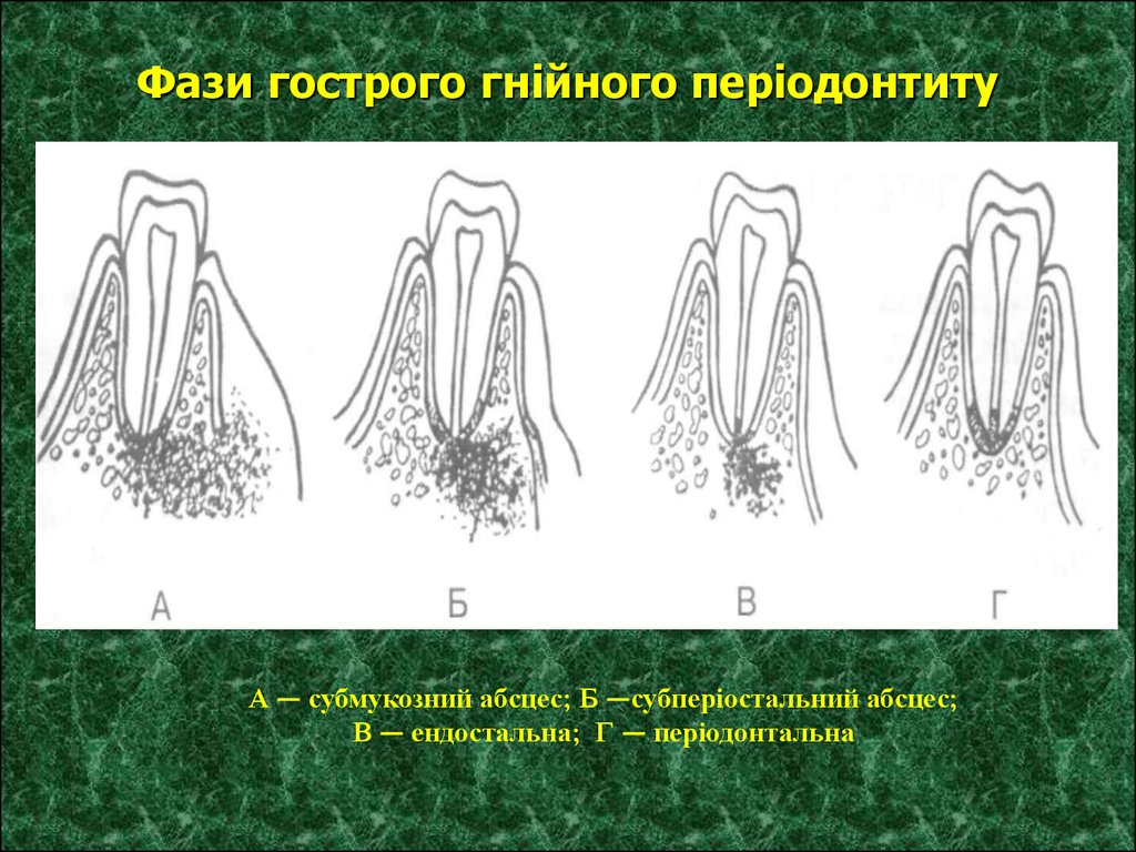 Острый периодонтит. Острый периодонтит серозный и Гнойный. Гнойный периодонтит острый периодонтит. Острый абсцесс периодонтит. Острый серозный периодонтит схема.