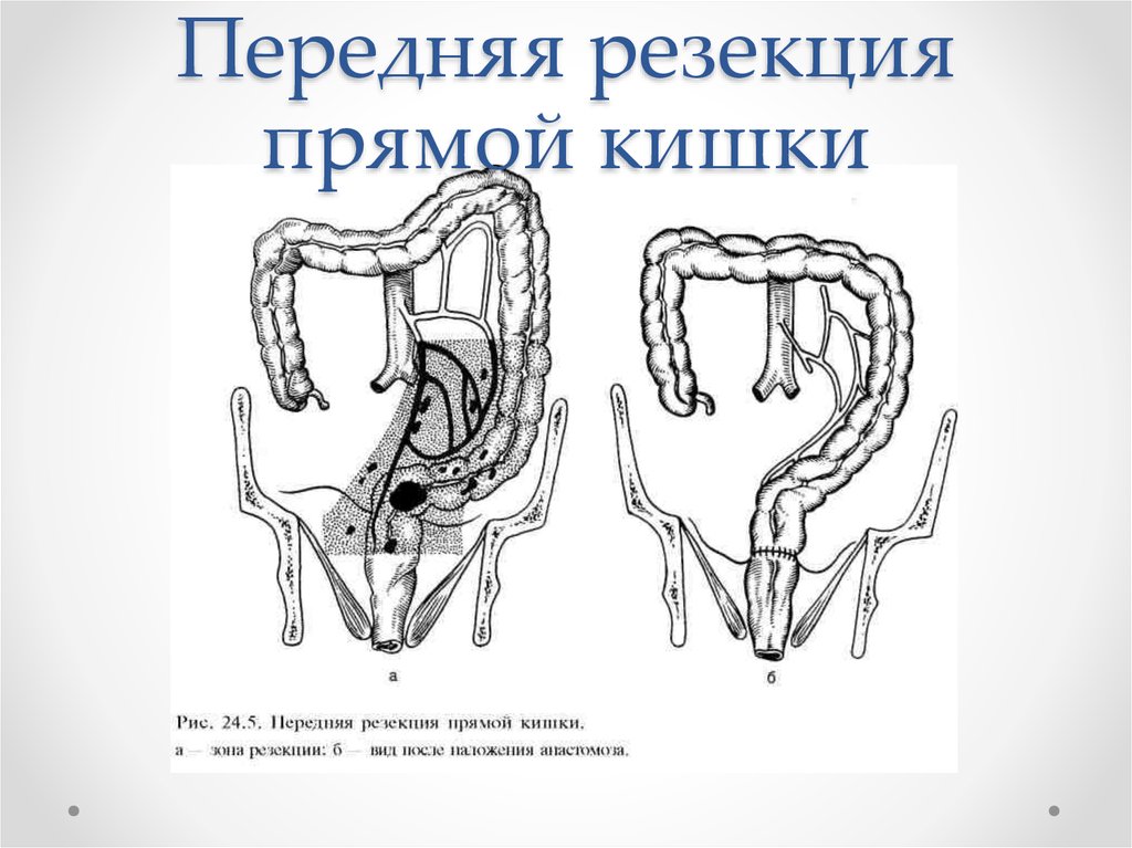 Схема операция гартмана