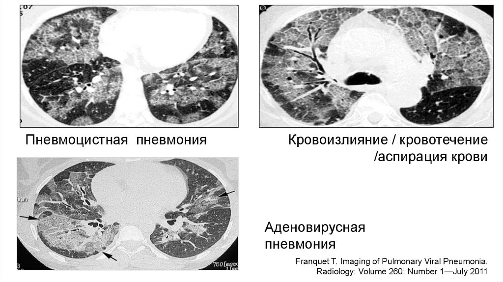 Пневмония 5. Кт при пневмоцистной пневмонии. Пневмоцистная пневмония на кт легких. Кт легких при пневмоцистной пневмонии. Пневмоцистная пневмония на кт при ВИЧ.