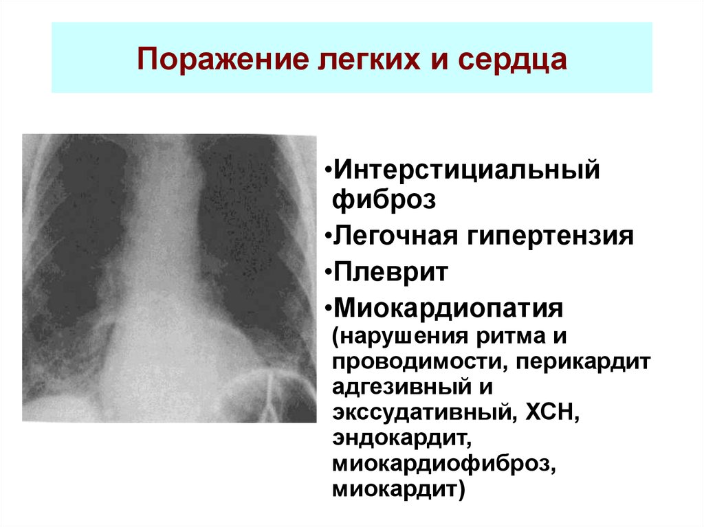 Фиброзная деформация легочного рисунка что это такое