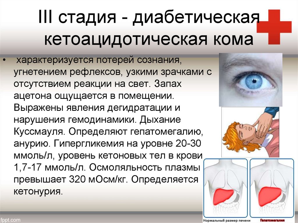 Кома раз. Кетоацидотическая кома характеризуется. Диабетической кетоацидотической комы. Диабетическая кетоацидотическая кома характеризуется. Кетоацидотическая кома стадии.