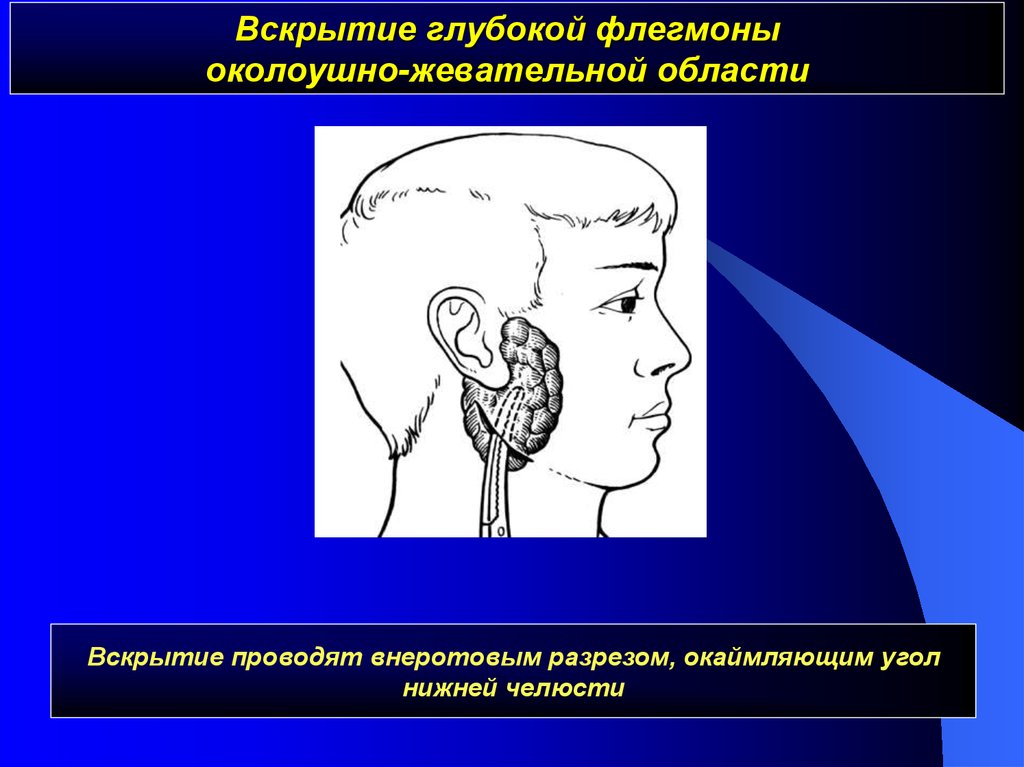 Вскрытие флегмон и абсцессов