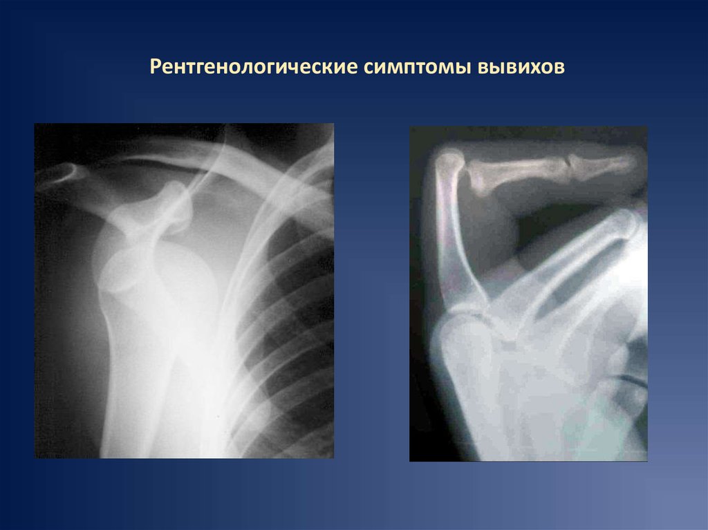 Подвывих. Подвывих вывих плечевого сустава рентген. Подвывих плечевого сустава рентген. Подвывих плечевого сустава рентген описание. Подвывих плечевой кости рентген.