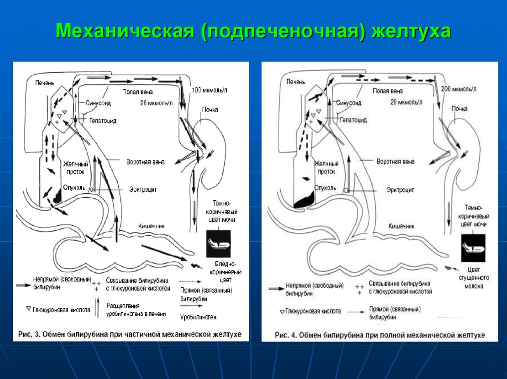 Механическая желтуха. Нарушения обмена билирубина при механической подпеченочной желтухи. Обмен билирубина при механической желтухе схема. Патогенез обтурационной желтухи. Механическая желтуха подпеченочная.