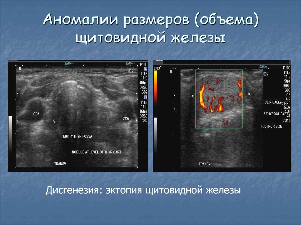 Ультразвуковое исследование паращитовидной железы