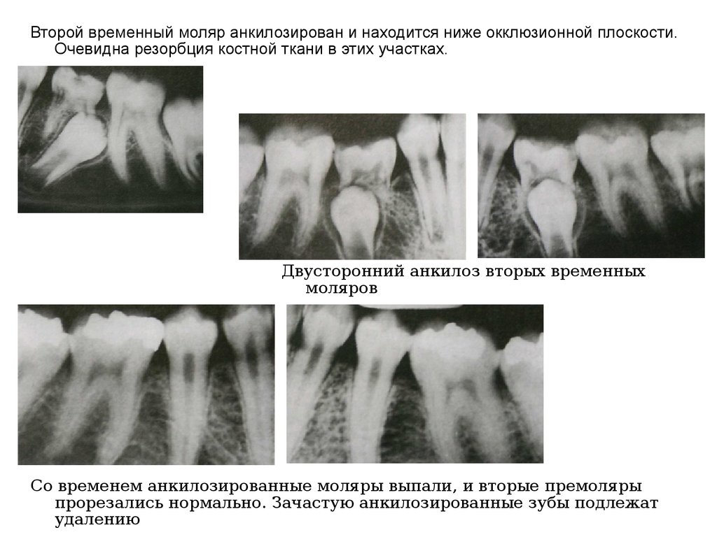 Второй временный. Резорбция костной ткани рентген. Перипротезная резорбция костной ткани. Резорбция кости остеокластами.