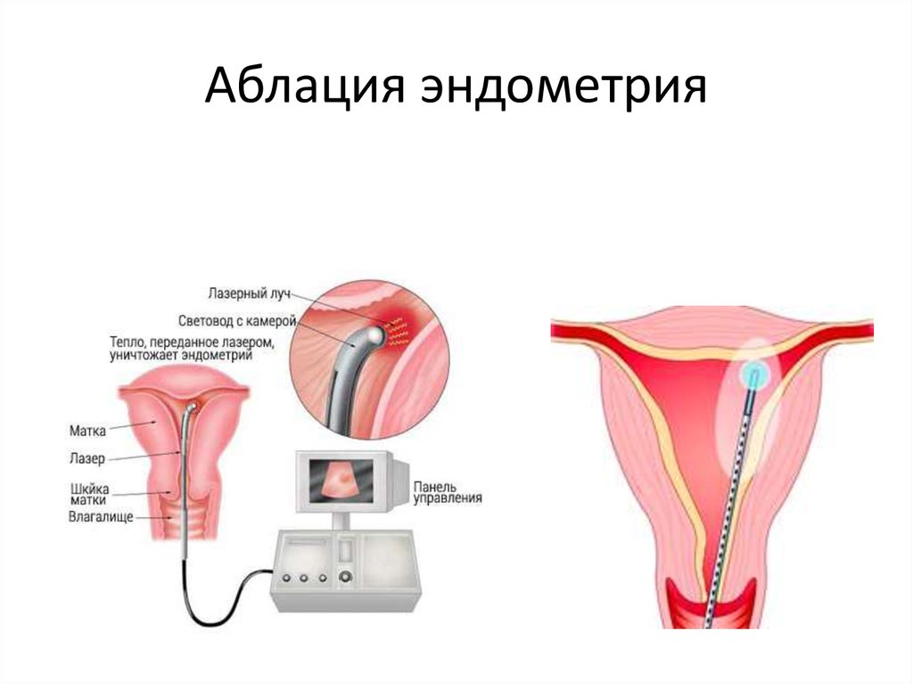 Женские эндометрии. Гиперплазия эндометрия эндометрит. Полип цервикального канала.