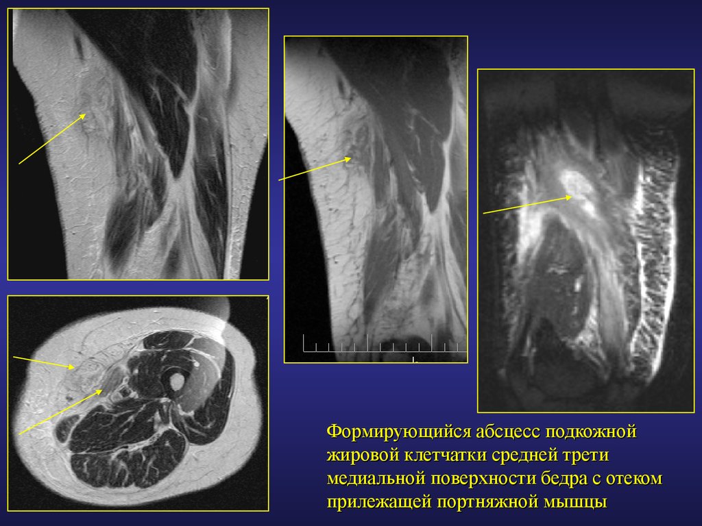 Мрт тканей. Абсцесс мягких тканей мрт. Абсцесс мягких тканей на кт. Отек мягких тканей на мрт. Флегмона мягких тканей на кт.