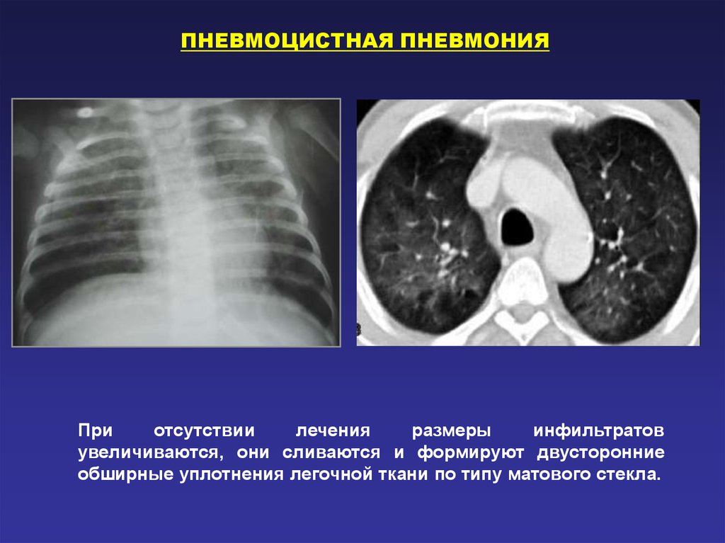 Пневмоцистная пневмония диагноз