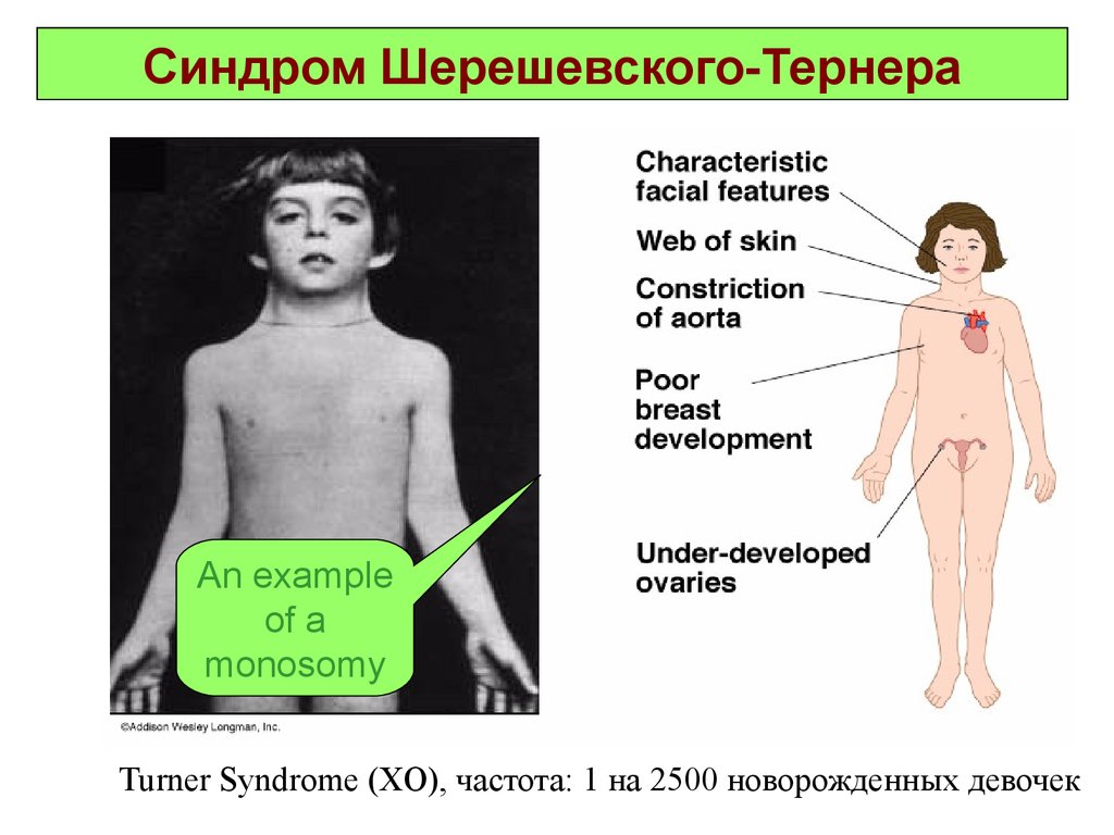 Синдром шерешевского тернера презентация