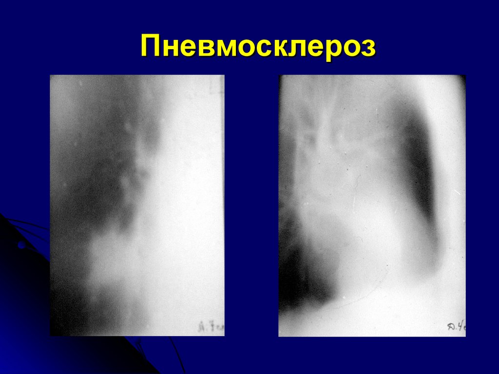 Диффузные изменения в легких. Пневмосклероз рентгенограмма. Пневмосклероз рентген. Перибронхитический пневмосклероз.