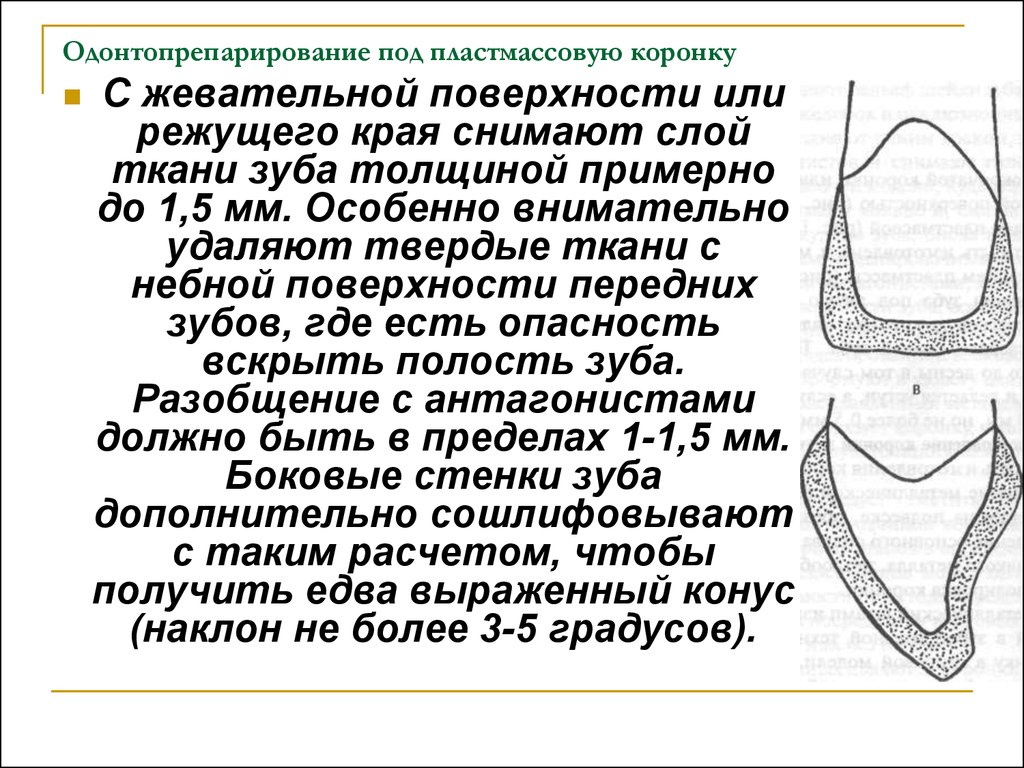 Препарирование под металлокерамическую коронку с уступом в картинках