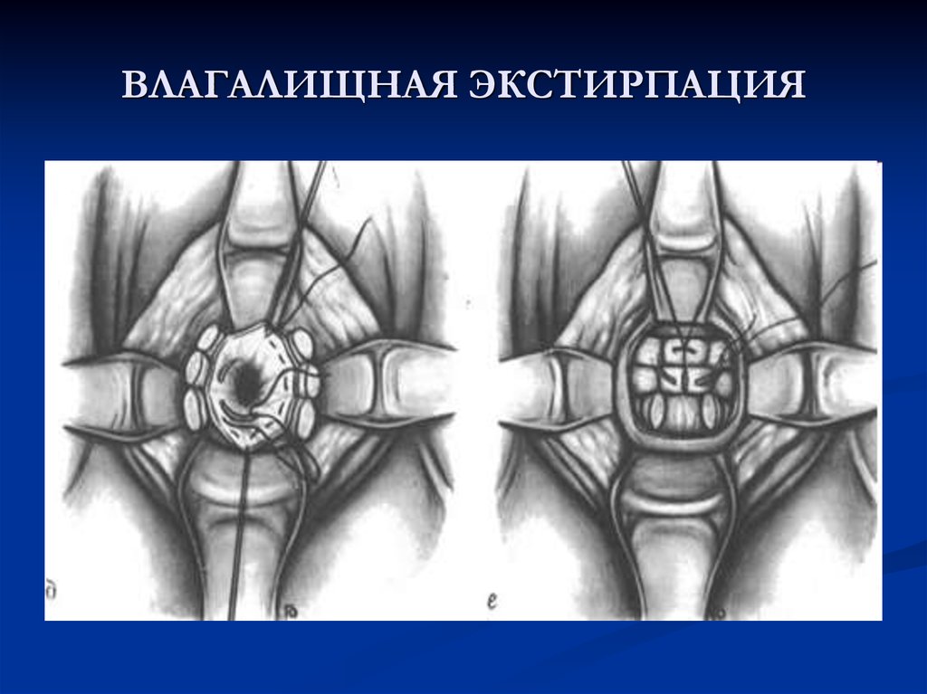 Экстирпация. Влагалищная экстирпация матки операция. Влагалищная экстирпация матки ход операции. Влагалищная тотальная гистерэктомия. Влагалищная гистерэктомия этапы операции.