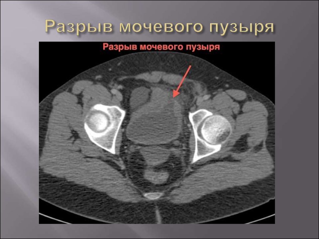 Мрт мочевого пузыря. Компьютерная томография мочевого пузыря. Травма мочевого пузыря кт. Кт при травме мочевого пузыря.