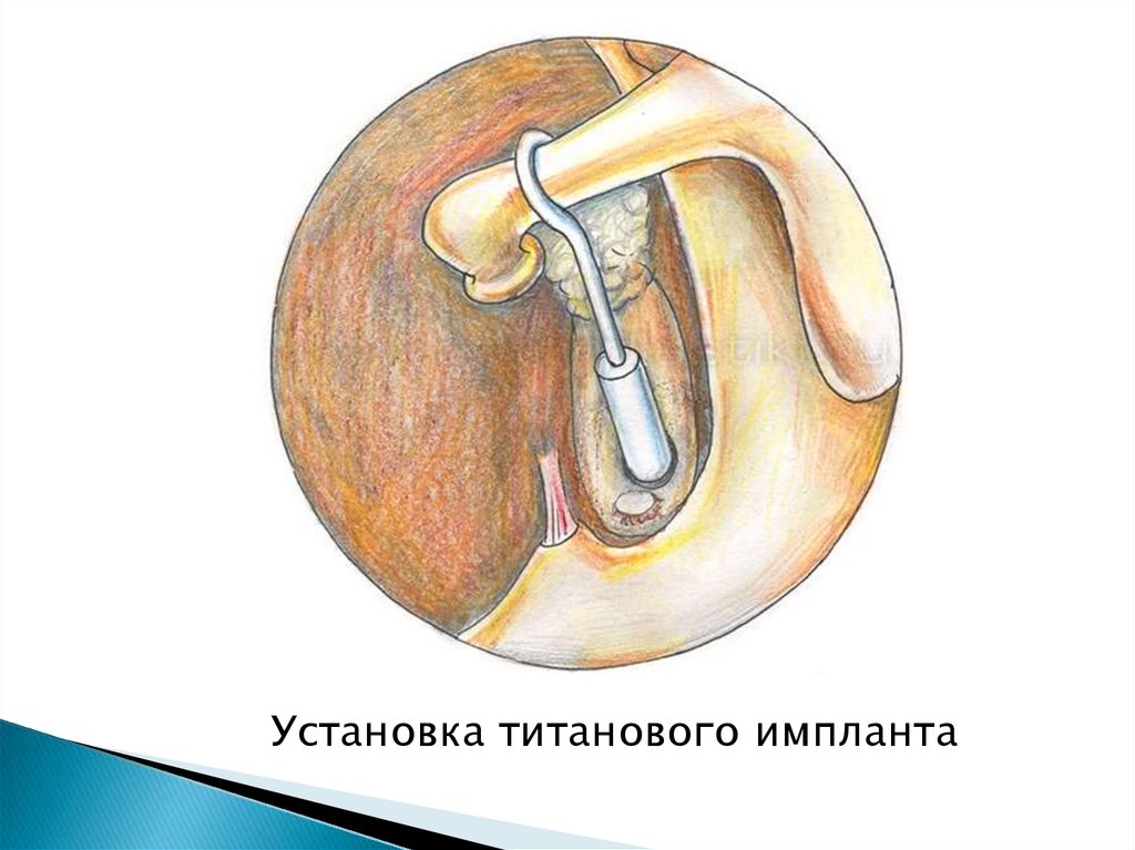 Стапедопластика. Отосклероз стапедопластика. Поршневая стапедопластика при отосклерозе. Операция стапедопластика при отосклерозе.