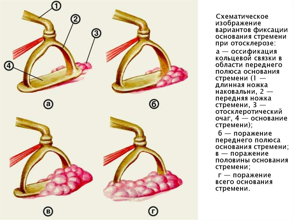 Стапедопластика. Отосклероз этиология. Формы отосклероза. Фиксация стремени при отосклерозе это.