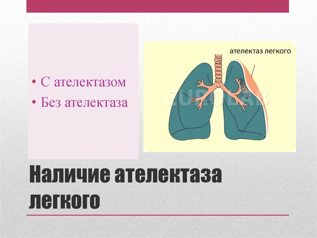 Ателектаз легкого. Ателектаз. Полный ателектаз легкого. Компрессионный ателектаз. Ателектазирование легких это.