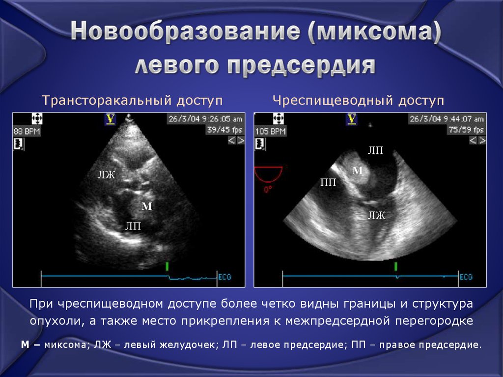 Чреспищеводная эхокардиография презентация