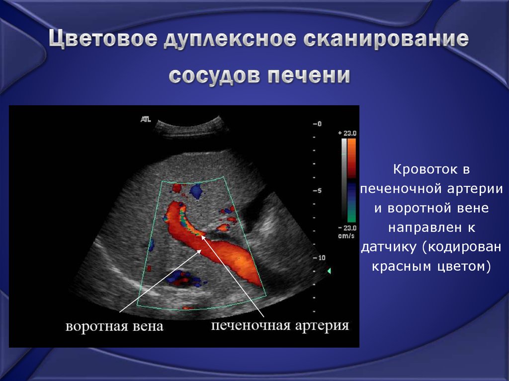 Норма портальной вене. Цветная дуплексная сонография печени. Кровоток по воротной Вене УЗИ. Допплерография портальной гипертензии. Воротная Вена печени на УЗИ.