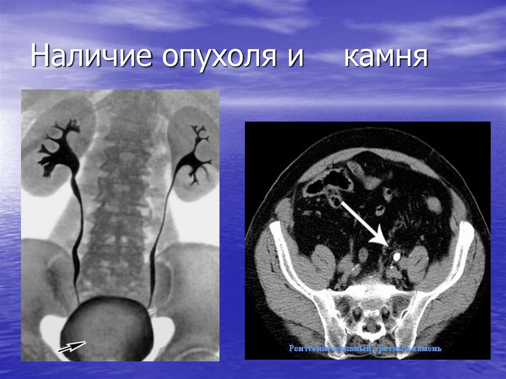 Мрт мочевого. Камни в мочевом пузыре мрт. Визуализация камня в мочевом пузыре на томографе. Мочевыделительная система УЗИ. Камни на мрт мочевого пузыря у женщин.