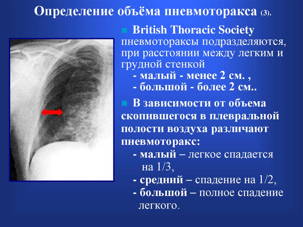 Гемоторакс карта вызова