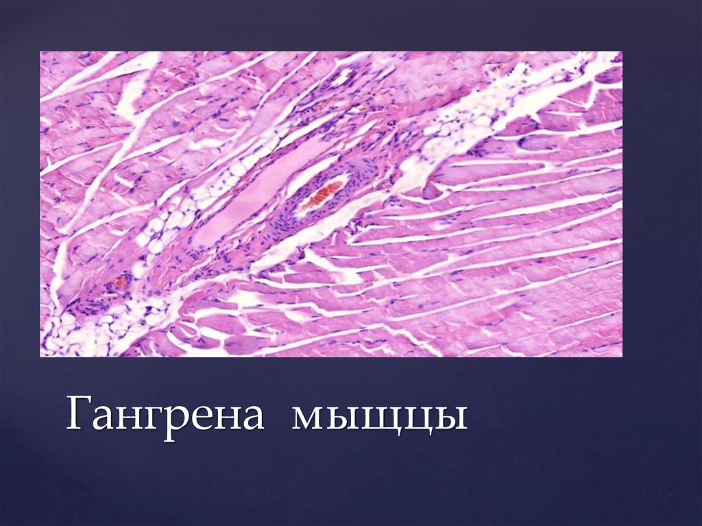 Патологическая картина. Гангрена патологическая анатомия. Гангрена кишечника гистология. Гангрена кишечника патанатомия. Гангрена кишки патологическая анатомия.