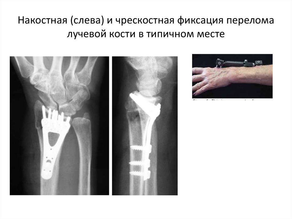 Закрытый оскольчатый перелом правой