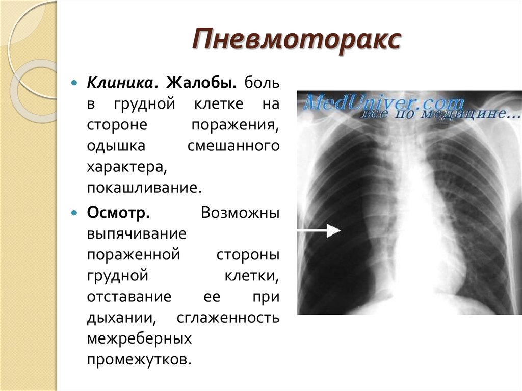 Правую половину грудной клетки. Пневмоторакс жалобы больного. Пневмоторакс клиника. Пневмоторакс грудной клетки. Жалобы при пневмотораксе.