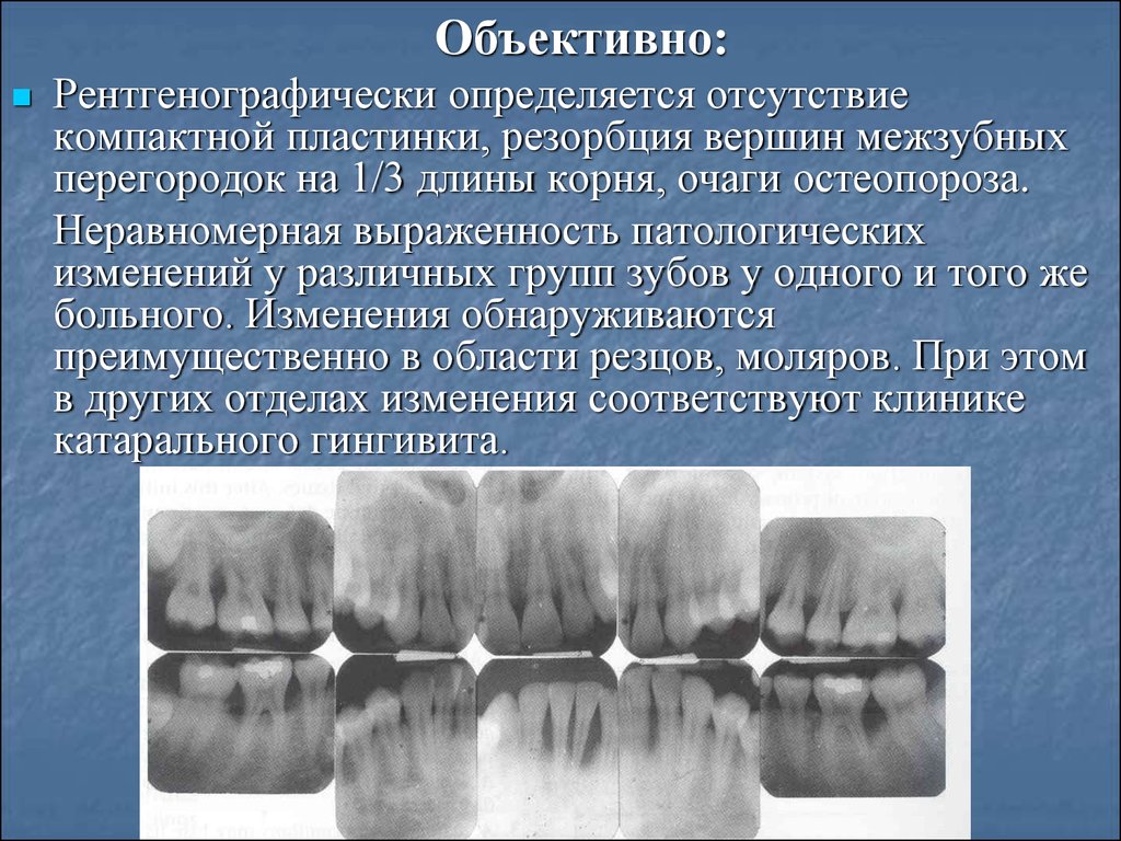 Резорбция это. Резорбция межзубных перегородок. Горизонтальная резорбция. Неравномерная резорбция. Резорбция компактной пластинки.