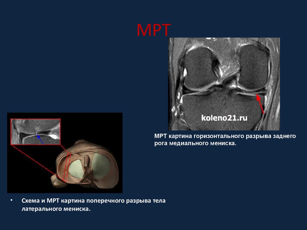 Мр картина повреждения внутреннего мениска 3а степени по stoller