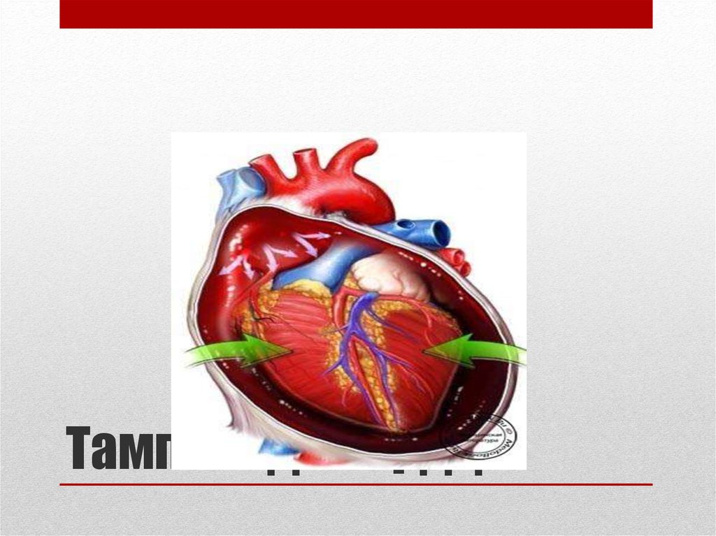 Сердце лево. Интраперикардиальная тампонада сердца. Тампонада сердца картинки. Тампонада сердца миокардит.