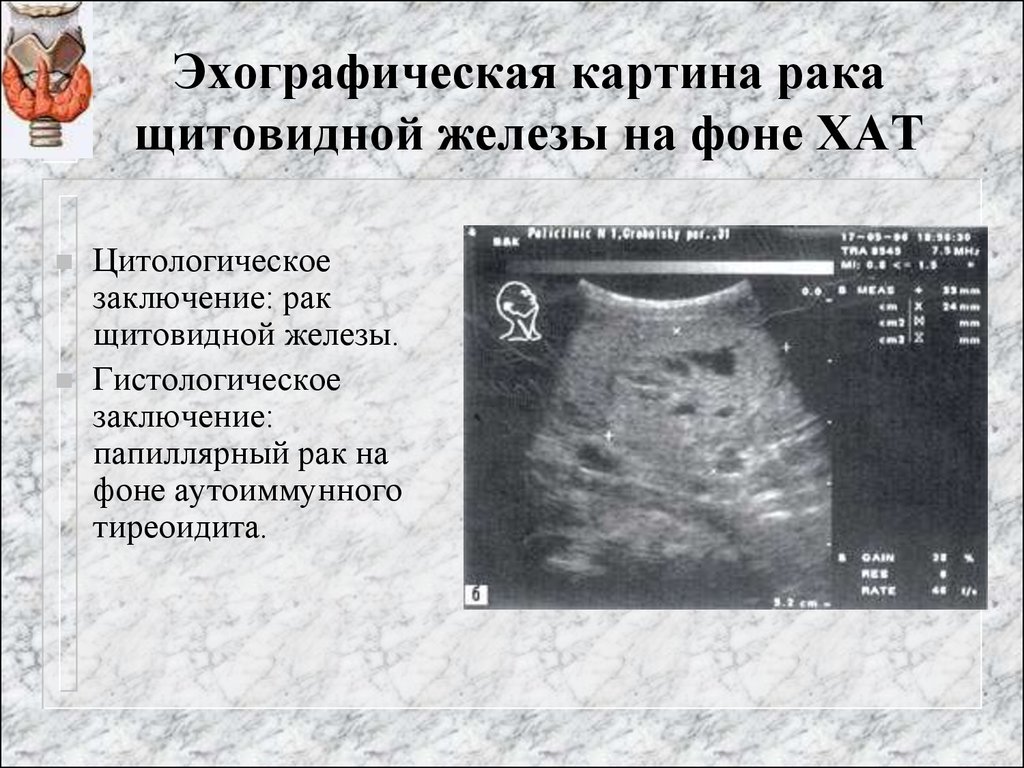 Рак щитовидки на узи. Аденокарцинома щитовидной железы УЗИ. УЗИ злокачественных узлов в щитовидной железе. Злокачественные образования щитовидной железы признаки на УЗИ. Раковый узел в щитовидной железе УЗИ.