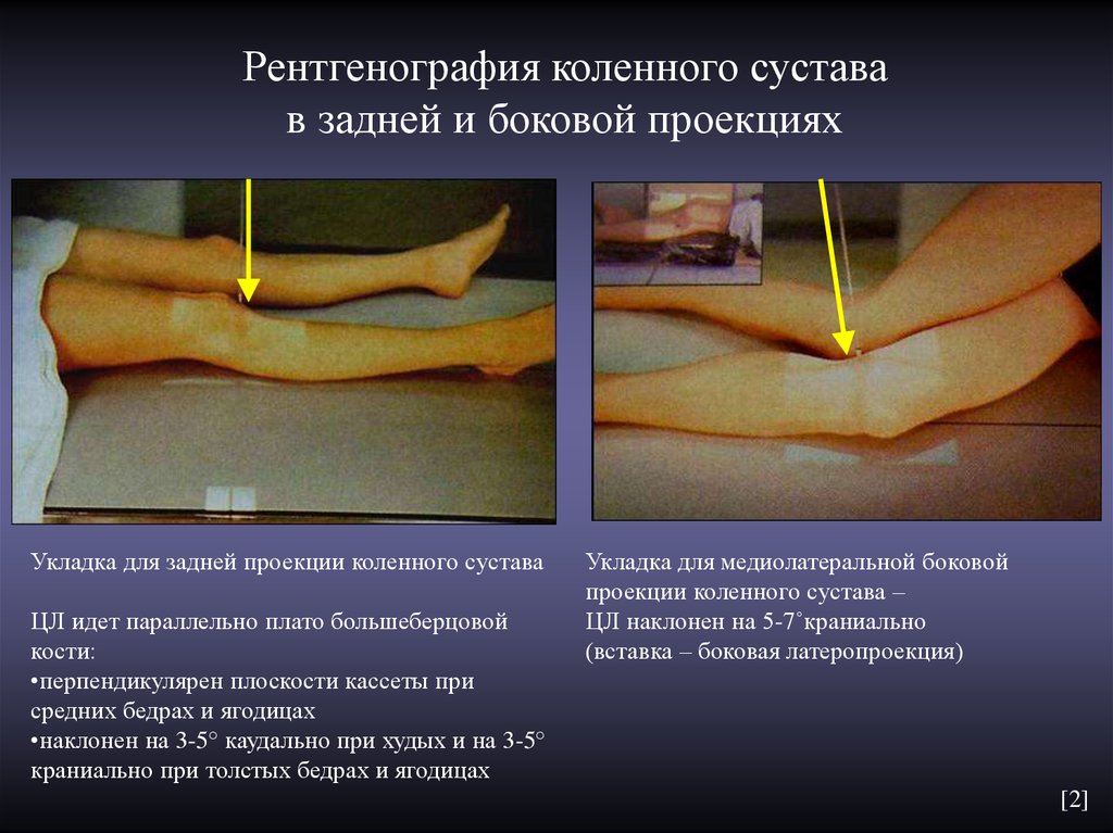 Суставы проекция. Укладка коленного сустава в боковой проекции. Укладка коленного сустава. Рентген коленного сустава укладка. Проекции рентгена коленного сустава.