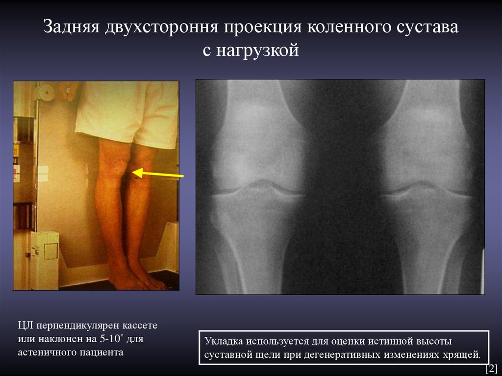 Рентген коленного сустава в двух проекциях фото в норме