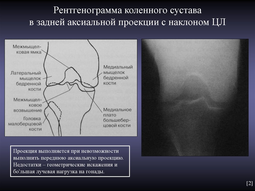 Суставы проекция. Аксиальная проекция коленного сустава в аксиальной проекции. Аксиальная проекция надколенника рентген. Рентген коленного сустава в аксиальной проекции. Укладка надколенника в аксиальной проекции.