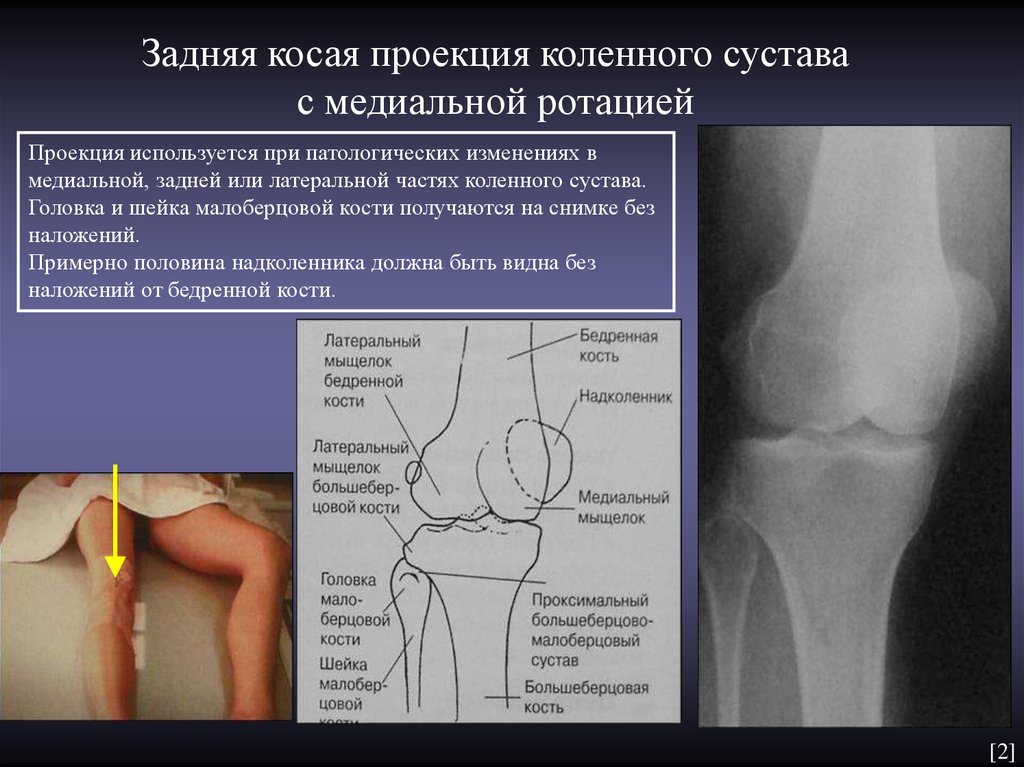 Контузионные изменения кости. Задняя проекция коленного сустава. Дисплазия внутреннего мыщелка бедренной кости. Рентгенография коленного сустава (2 проекции). Рентгенограмма коленного сустава в задней проекции.