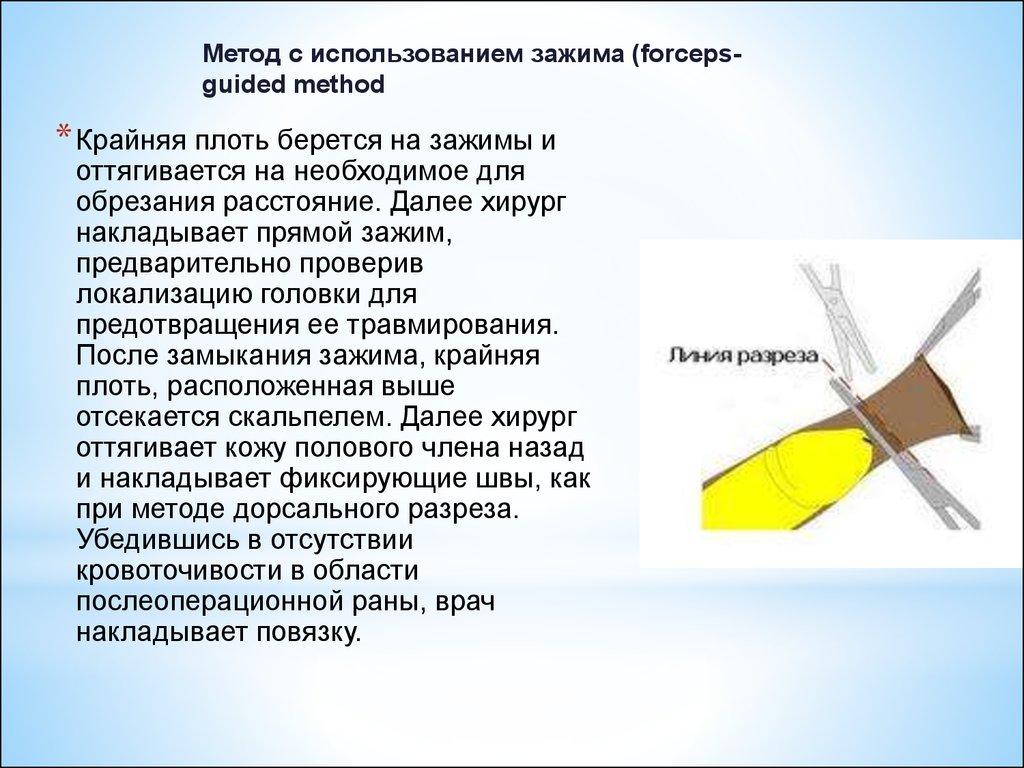 Как делается обрезание у мужчин схема и зачем