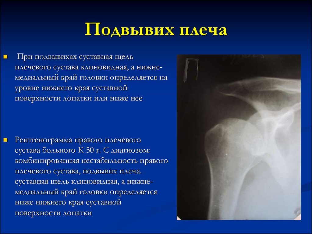 Смещение плечевой кости. Подвывих плечевого сустава рентген. Подвывих вывих плечевого сустава рентген. Вывих плечевого сустава рентген. Верхний подвывих плечевого сустава рентген.