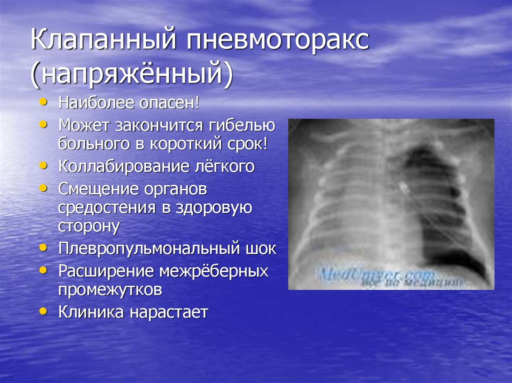 Карта смп пневмоторакс спонтанный