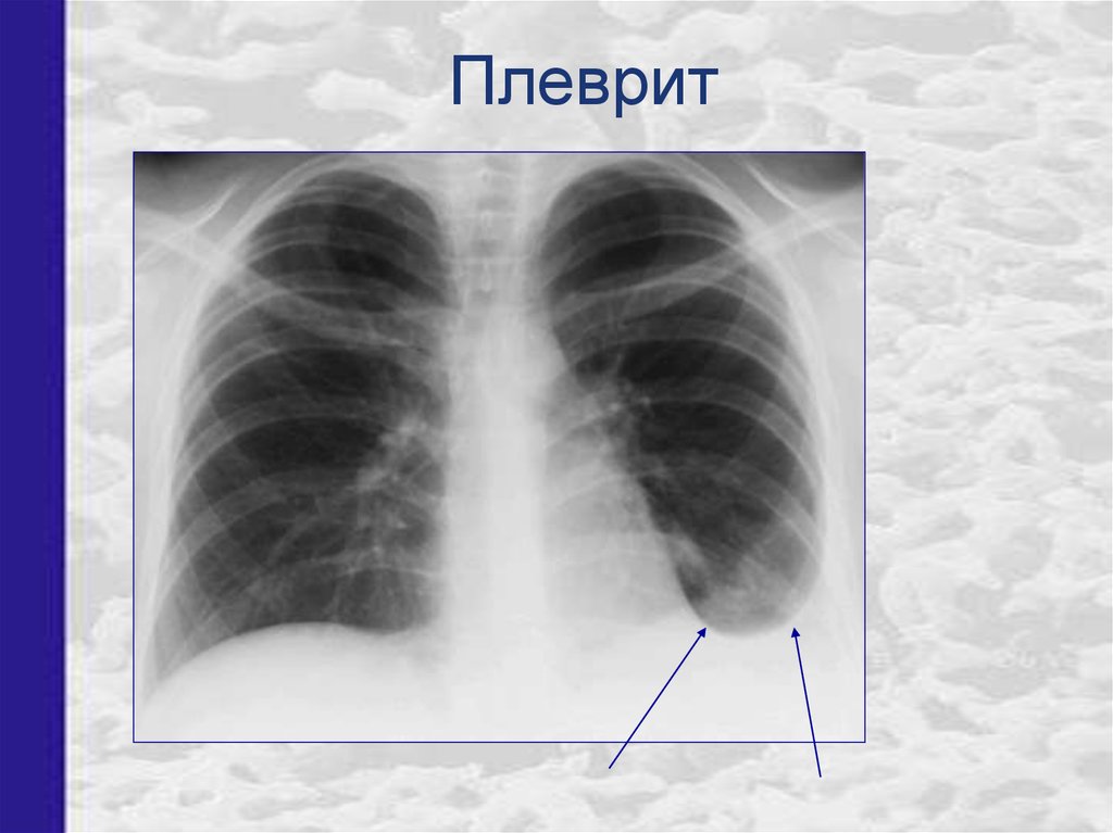 Плеврит что это. Сухой плеврит рентген. Перифокальный плеврит рентген. Костальный плеврит рентген. Фиброзный плеврит рентген.